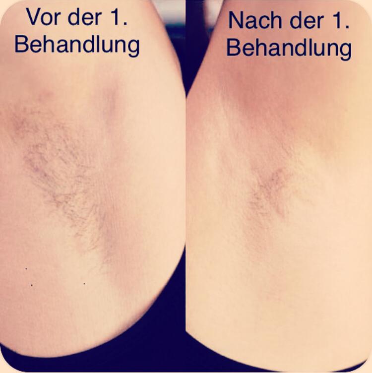 Laserbehandlung Vergleich