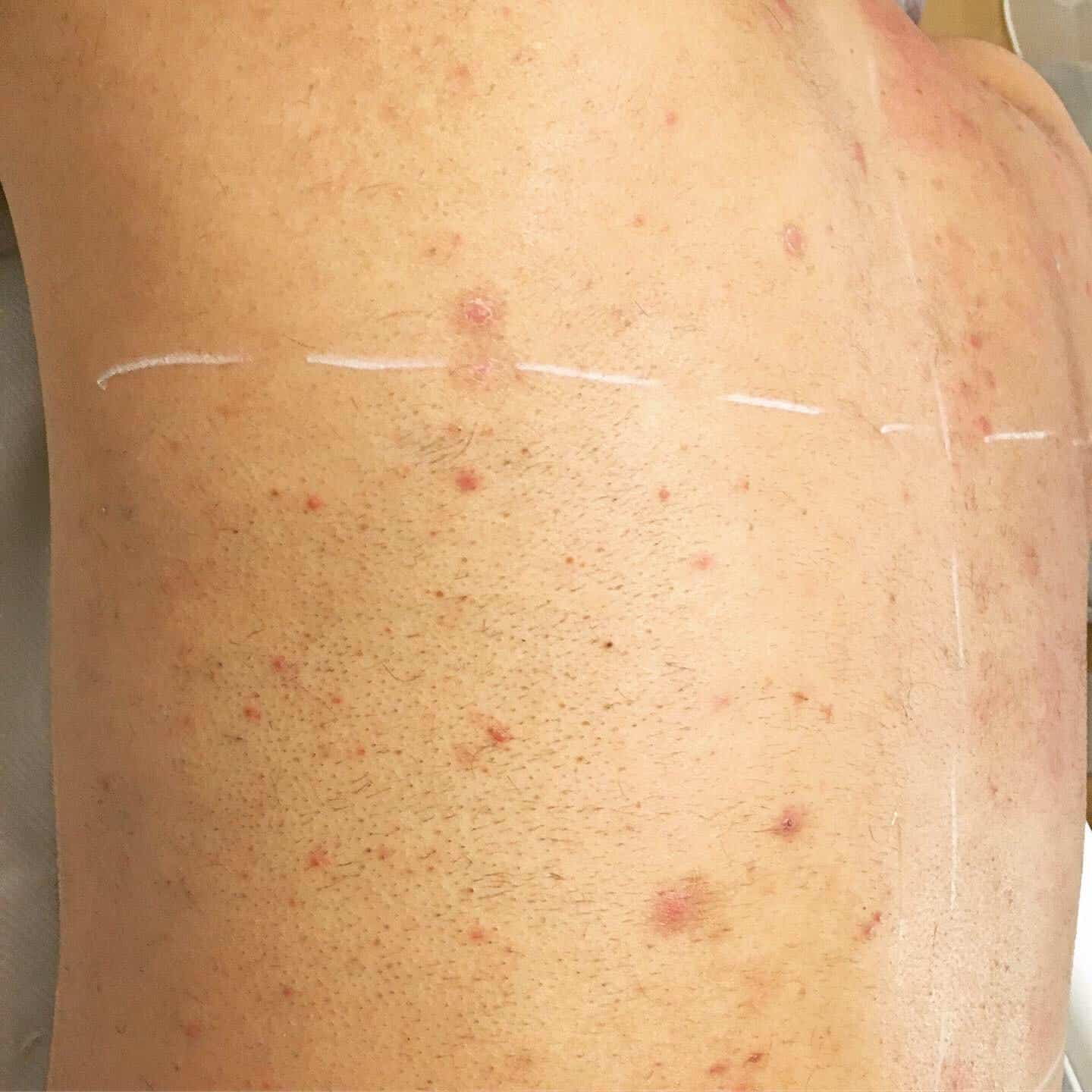 Rückenhaare vor der Laserbehandlung