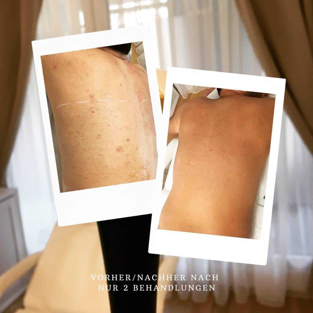 Rückenhaare nach 2 Behandlungen