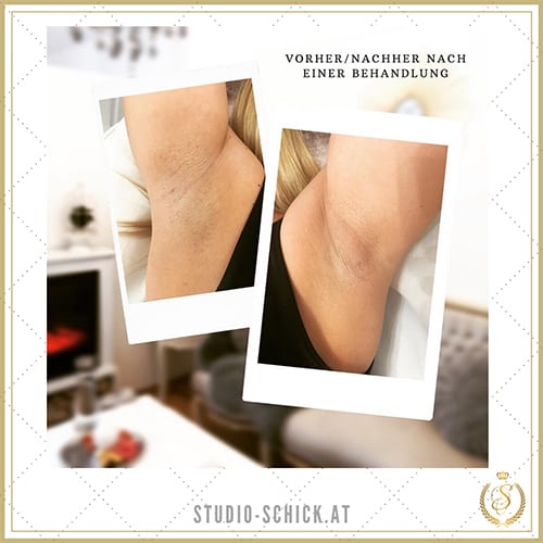 Erfahrungen mit dauerhafter Haarentfernung